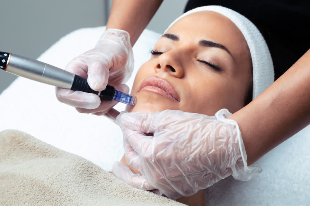 Revitalize And Renew: The Power Of Microneedling For Skin Rejuvenation